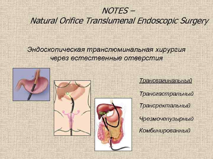 NOTES – Natural Orifice Translumenal Endoscopic Surgery Эндоскопическая транслюминальная хирургия через естественные отверстия Трансвагинальный