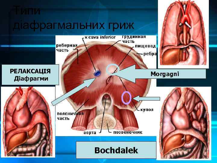 Типи діафрагмальних гриж РЕЛАКСАЦІЯ Діафрагми Morgagni Bochdalek 