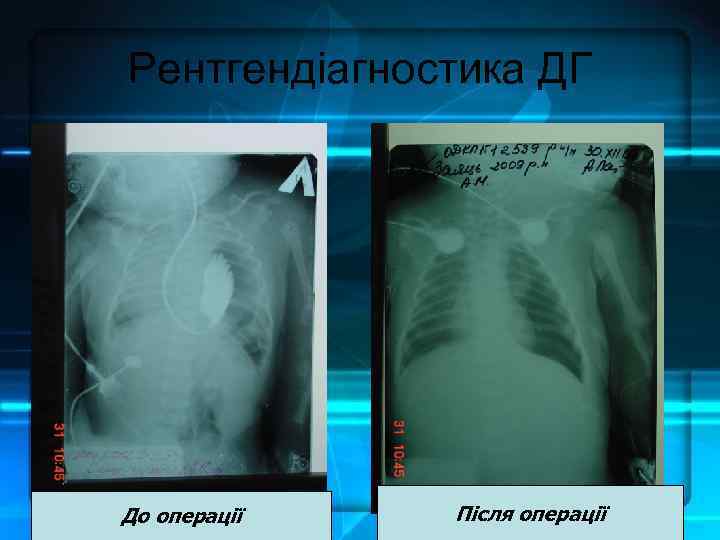 Рентгендіагностика ДГ До операції Після операції 