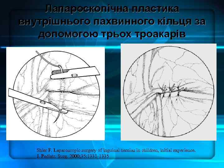 Лапароскопічна пластика внутрішнього пахвинного кільця за допомогою трьох троакарів Shier F. Laparoscopic surgery of