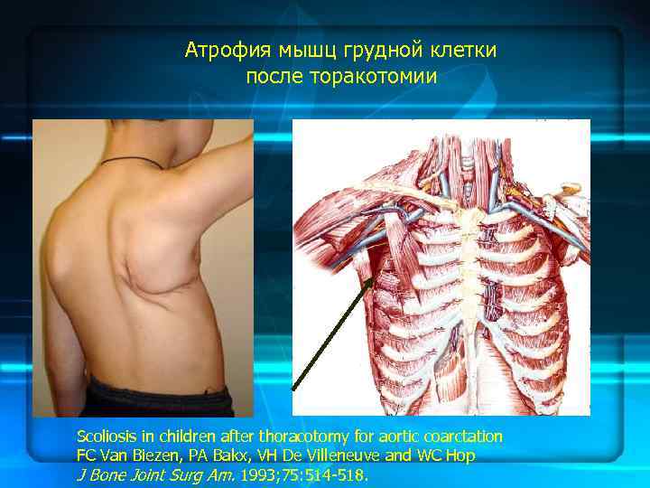 Атрофия мышц грудной клетки после торакотомии Scoliosis in children after thoracotomy for aortic coarctation