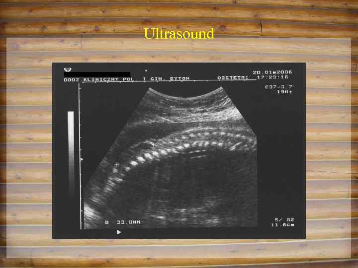 Ultrasound 