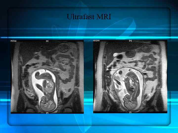 Ultrafast MRI 