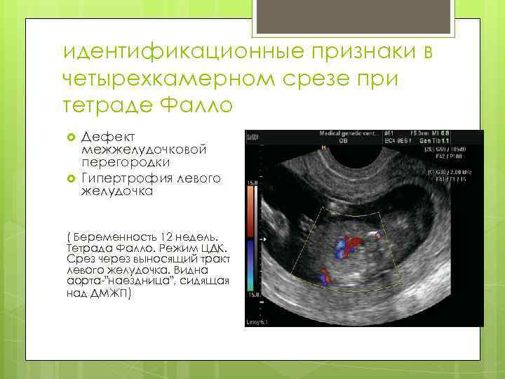 идентификационные признаки в четырехкамерном срезе при тетраде Фалло Дефект межжелудочковой перегородки Гипертрофия левого желудочка