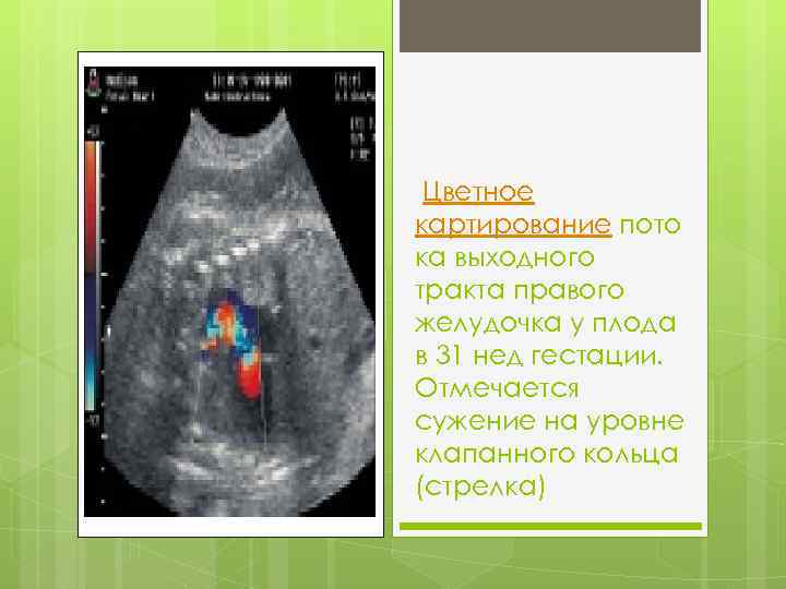  Цветное картирование пото ка выходного тракта правого желудочка у плода в 31 нед