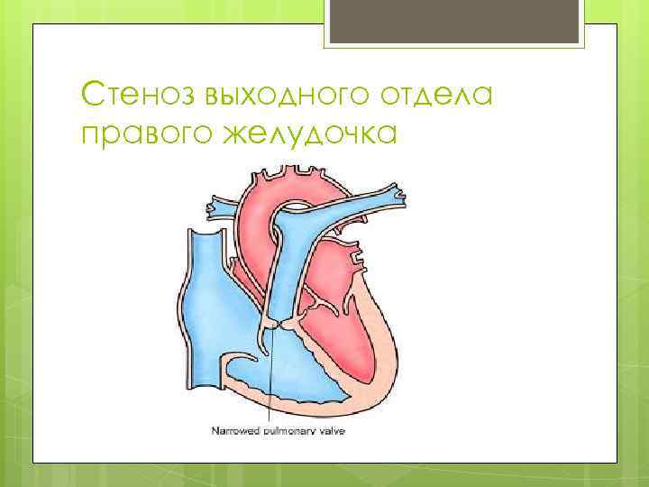 Стеноз выходного отдела правого желудочка 