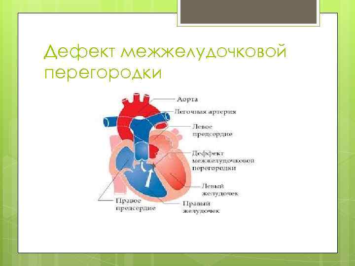 Дефект межжелудочковой перегородки 