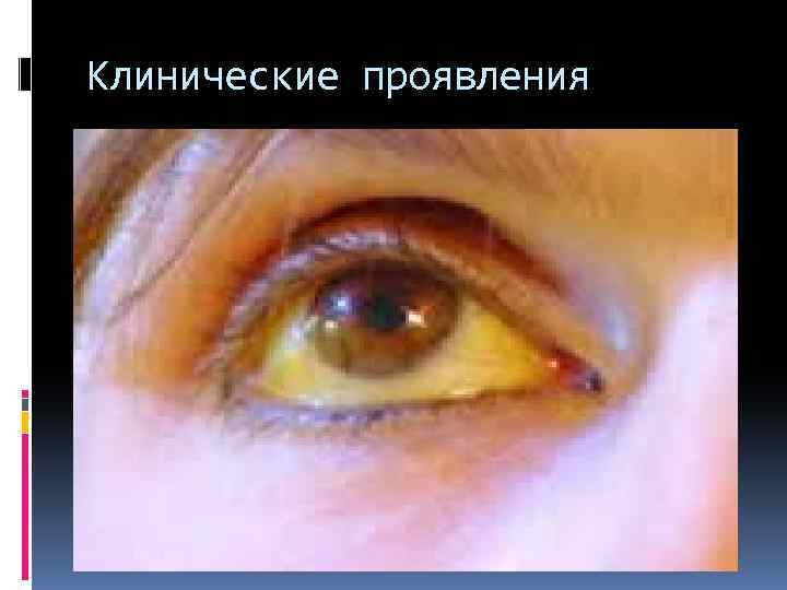 Клинические проявления 