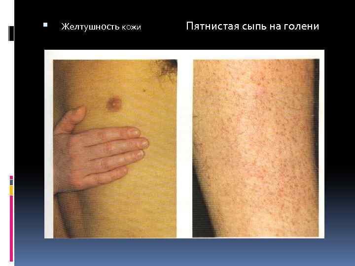  Желтушность кожи Пятнистая сыпь на голени 
