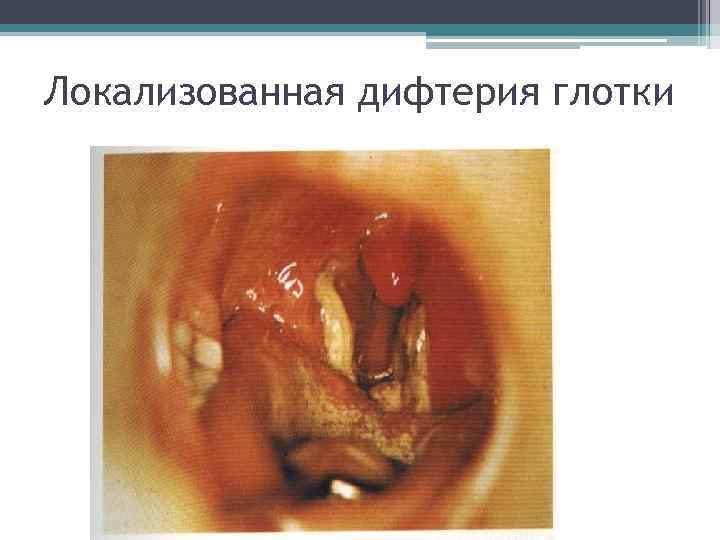 Локализованная дифтерия глотки 
