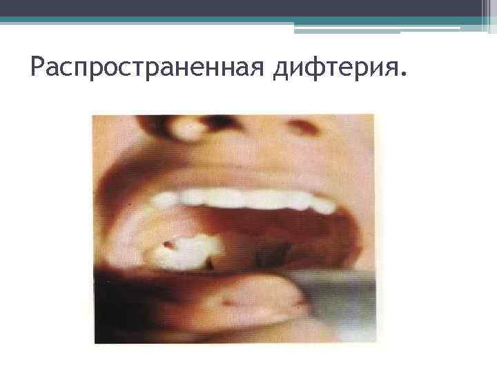 Распространенная дифтерия. 