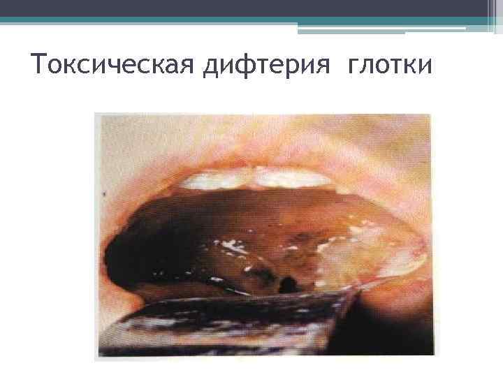 Токсическая дифтерия глотки 