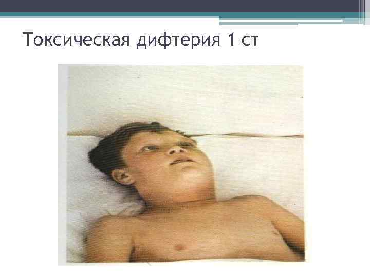 Токсическая дифтерия 1 ст 