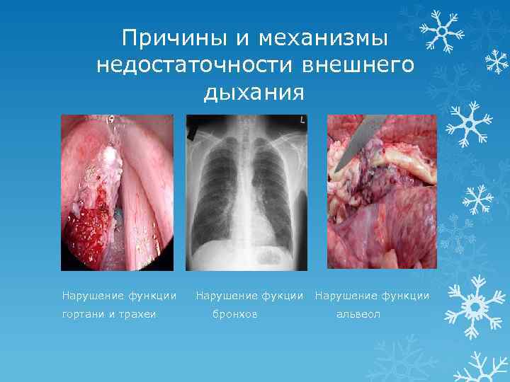 Причины и механизмы недостаточности внешнего дыхания Нарушение функции гортани и трахеи Нарушение фукции бронхов