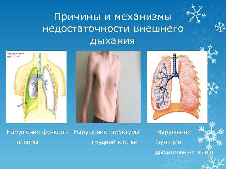 Причины и механизмы недостаточности внешнего дыхания Нарушение функции плевры Нарушение структуры грудной клетки Нарушение