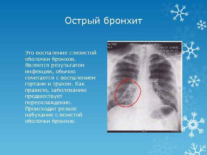 Острый бронхит Это воспаление слизистой оболочки бронхов. Является результатом инфекции, обычно сочетается с воспалением