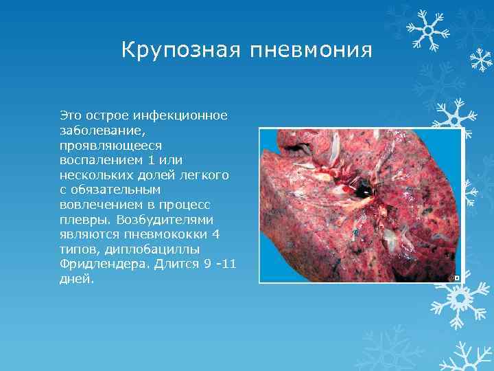 Крупозная пневмония Это острое инфекционное заболевание, проявляющееся воспалением 1 или нескольких долей легкого с