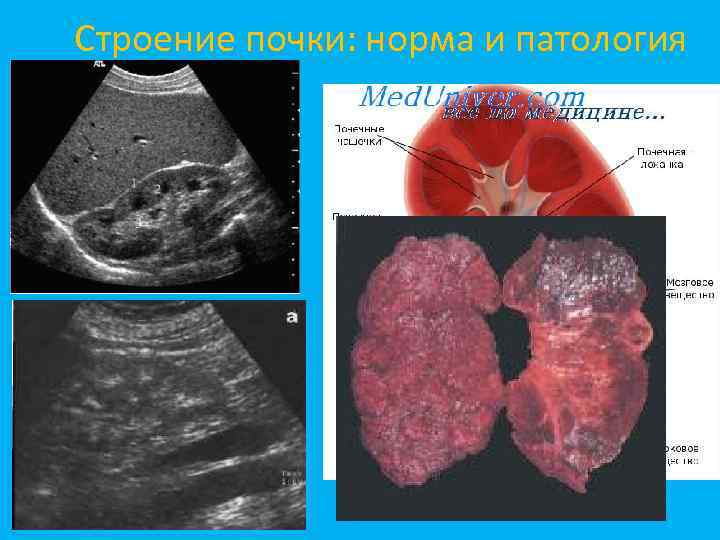 Строение почки: норма и патология 