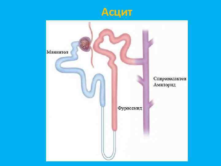 Асцит 