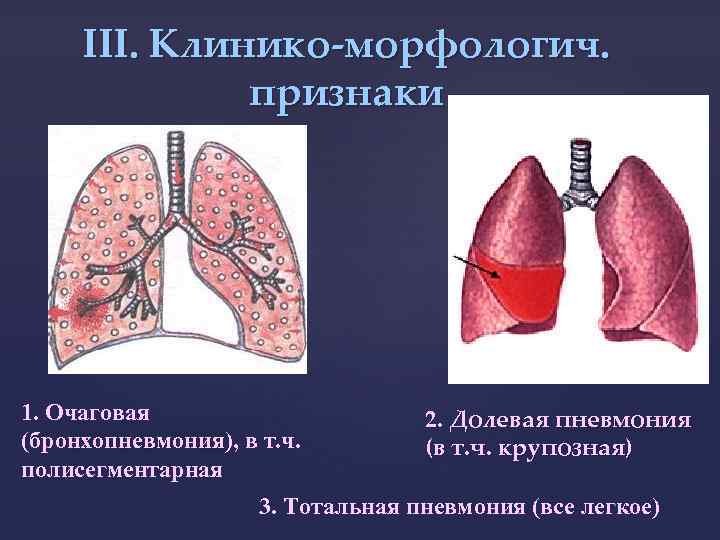 III. Клинико-морфологич. признаки 1. Очаговая (бронхопневмония), в т. ч. бронхопневмония полисегментарная 2. Долевая пневмония