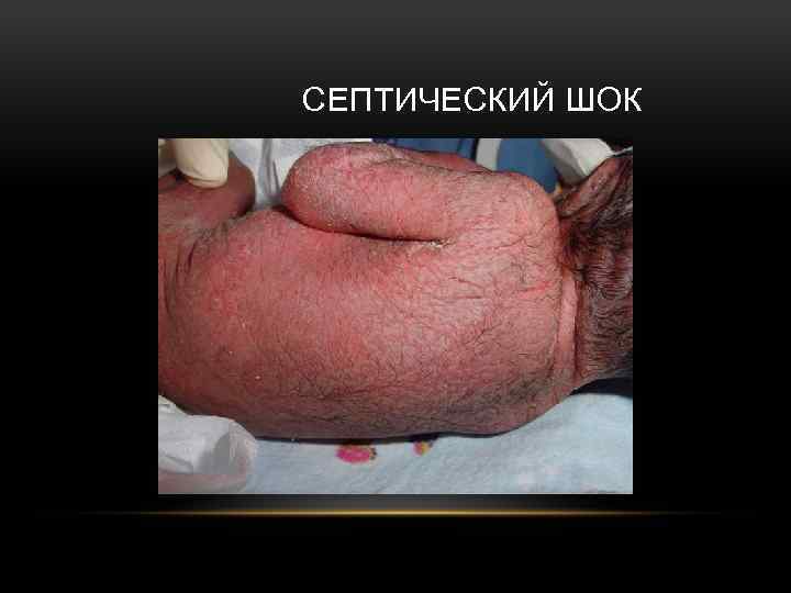 СЕПТИЧЕСКИЙ ШОК 