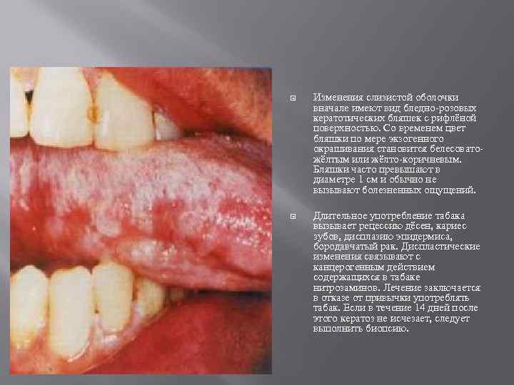  Изменения слизистой оболочки вначале имеют вид бледно-розовых кератотических бляшек с рифлёной поверхностью. Со