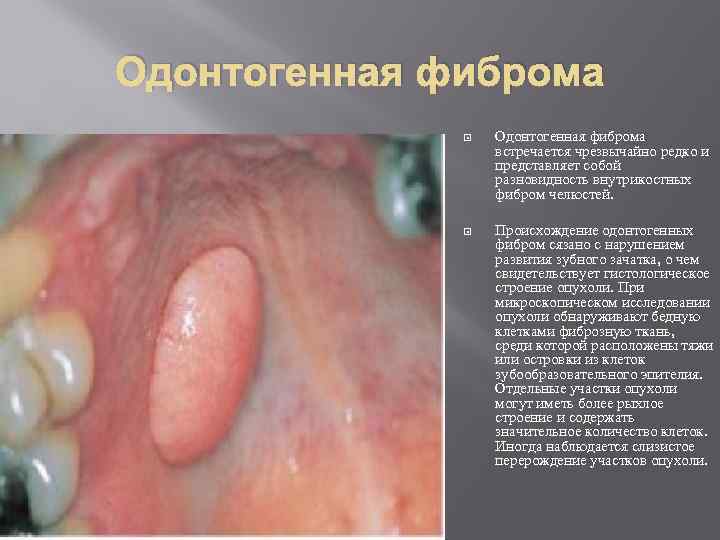 Одонтогенная фиброма встречается чрезвычайно редко и представляет собой разновидность внутрикостных фибром челюстей. Происхождение одонтогенных