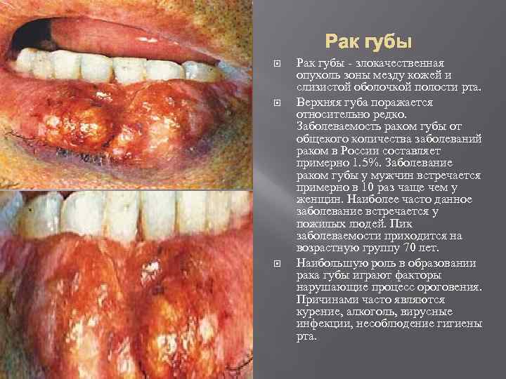 Рак губы Рак губы - злокачественная опухоль зоны мезду кожей и слизистой оболочкой полости
