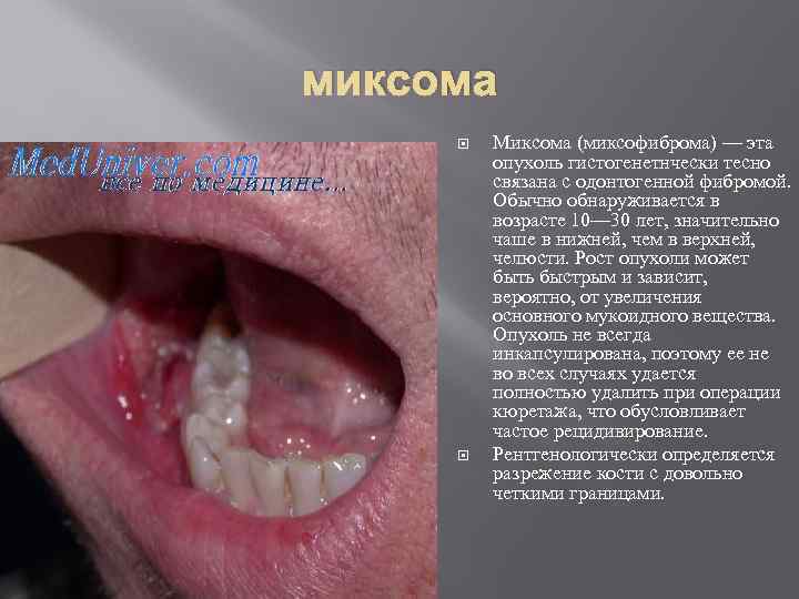 миксома Миксома (миксофиброма) — эта опухоль гистогенетнчески тесно связана с одонтогенной фибромой. Обычно обнаруживается