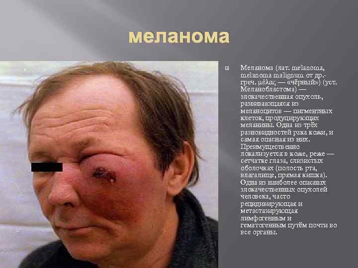 меланома Меланома (лат. melanoma, melanoma malignum от др. греч. μέλας — «чёрный» ) (уст.