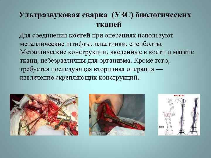 Ультразвуковая сварка (УЗС) биологических тканей Для соединения костей при операциях используют металлические штифты, пластинки,