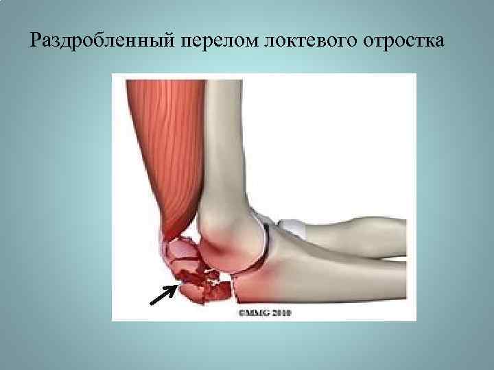 Раздробленный перелом локтевого отростка 
