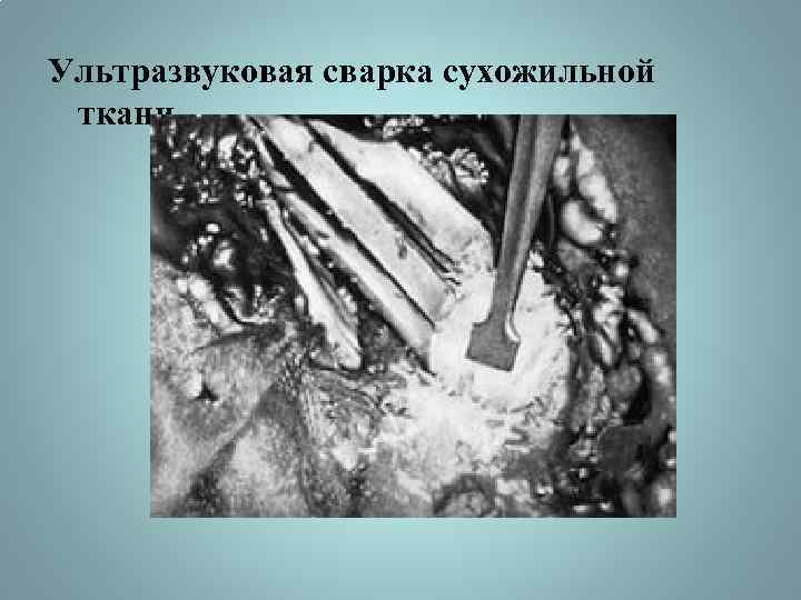 Ультразвуковая сварка сухожильной ткани 