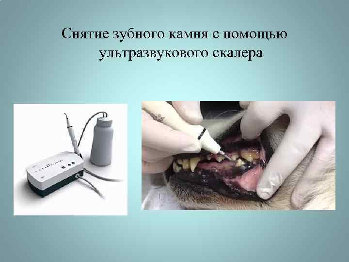 Снятие зубного камня с помощью ультразвукового скалера 