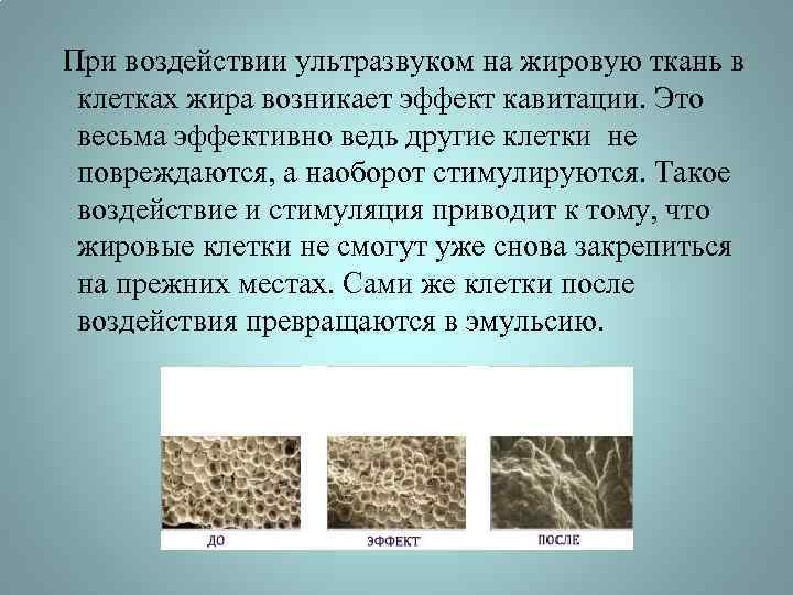  При воздействии ультразвуком на жировую ткань в клетках жира возникает эффект кавитации. Это