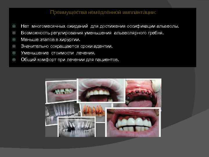 Преимущества немедленной имплантации: Нет многомесячных ожиданий для достижения оссификации альвеолы. Возможность регулирования уменьшения альвеолярного