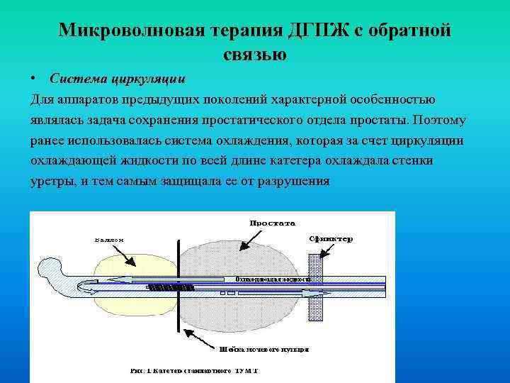 Микроволновая терапия ДГПЖ с обратной связью • Система циркуляции Для аппаратов предыдущих поколений характерной