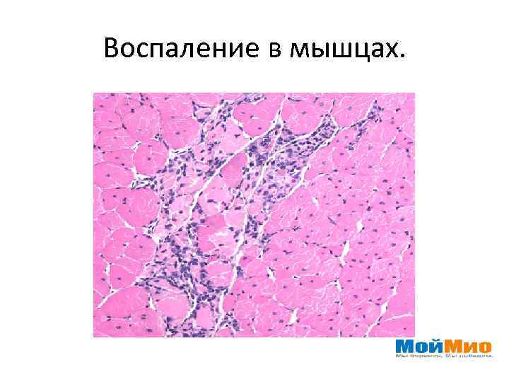 Воспаление в мышцах. 