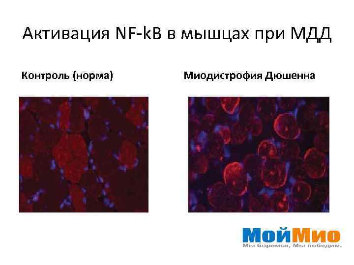 Активация NF-k. B в мышцах при МДД Контроль (норма) Миодистрофия Дюшенна 