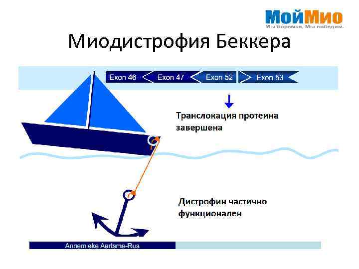 Миодистрофия Беккера 