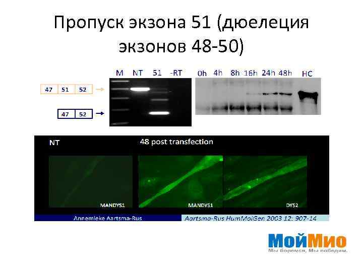 Пропуск экзона 51 (дюелеция экзонов 48 -50) 