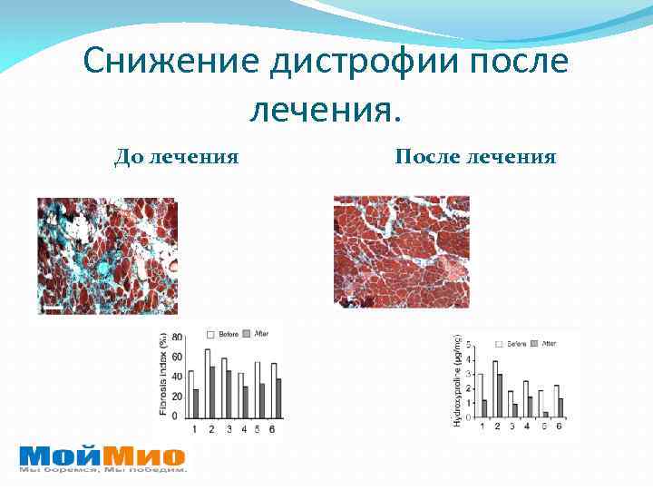 Снижение дистрофии после лечения. До лечения После лечения 