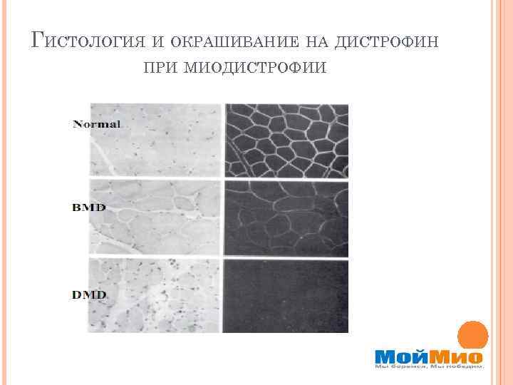 ГИСТОЛОГИЯ И ОКРАШИВАНИЕ НА ДИСТРОФИН ПРИ МИОДИСТРОФИИ 