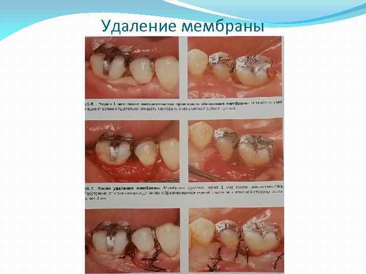 Удаление мембраны 