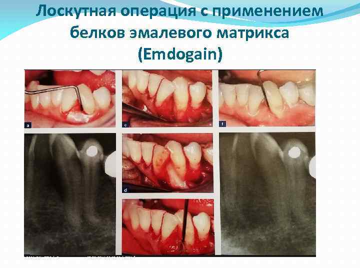 Лоскутная операция с применением белков эмалевого матрикса (Emdogain) 