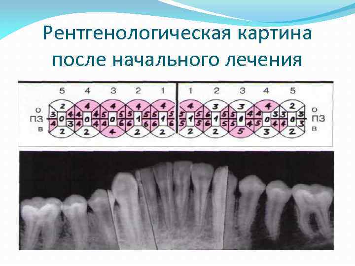 Рентгенологическая картина после начального лечения 