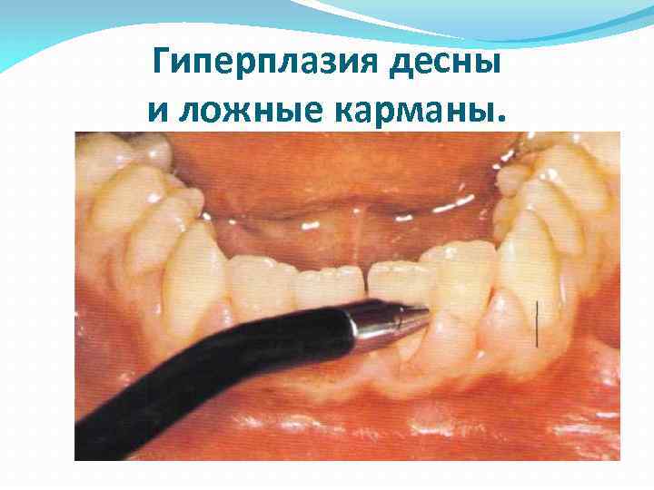 Гиперплазия десны и ложные карманы. 