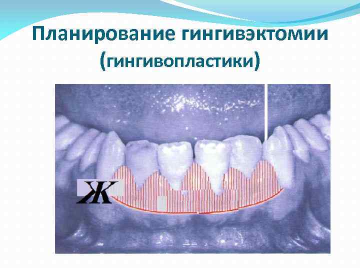 Планирование гингивэктомии (гингивопластики) 