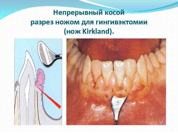 Непрерывный косой разрез ножом для гингивэктомии (нож Kirkland). 