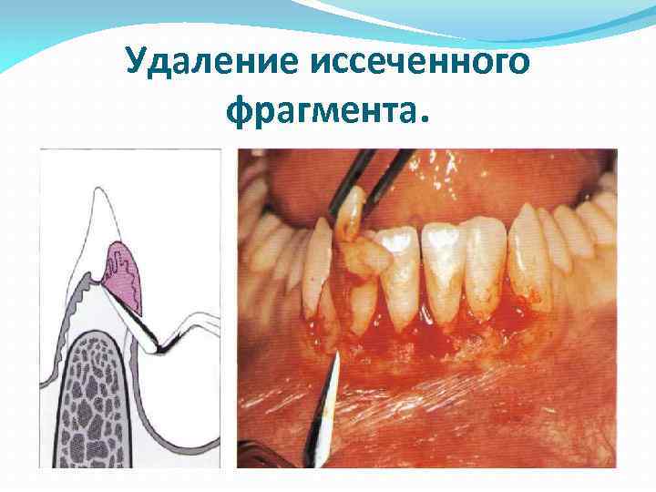 Удаление иссеченного фрагмента. 